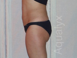 A photo of someone receiving Aqualyx treatment.