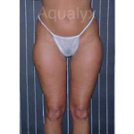 A photo of someone receiving Aqualyx treatment.
