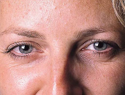 A photo of someone receiving Anti-Wrinkle Treatment treatment.