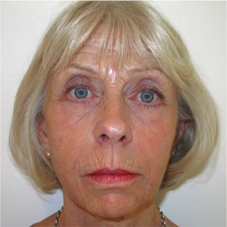 A photo of someone receiving Dermal Fillers treatment.