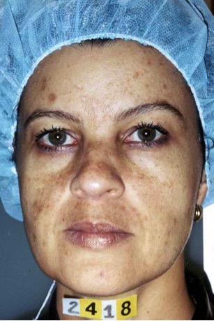 A photo of someone receiving Dermamelan treatment.