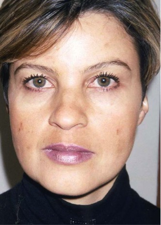 A photo of someone receiving Dermamelan treatment.