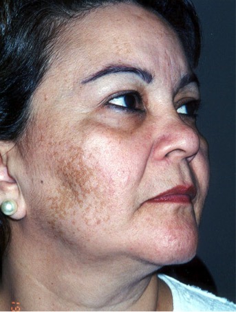 A photo of someone receiving Dermamelan treatment.