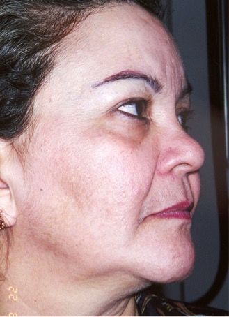 A photo of someone receiving Dermamelan treatment.