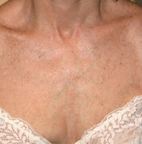 A photo of someone receiving IPL Skin Rejuvenation treatment.