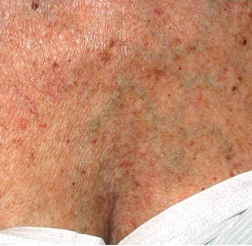 A photo of someone receiving IPL Skin Rejuvenation treatment.