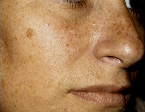 A photo of someone receiving IPL Skin Rejuvenation treatment.