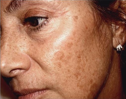 A photo of someone receiving IPL Skin Rejuvenation treatment.