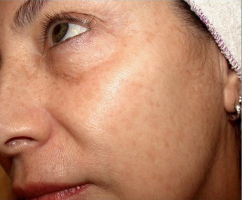 A photo of someone receiving IPL Skin Rejuvenation treatment.