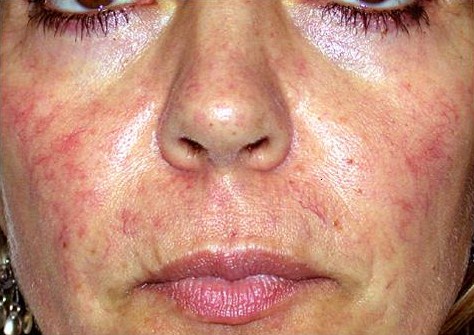 A photo of someone receiving IPL Skin Rejuvenation treatment.