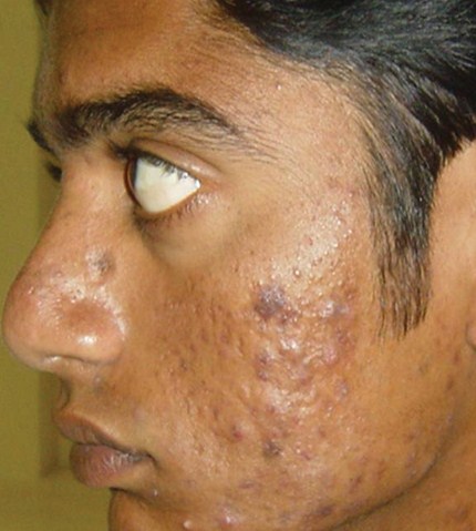 A photo of someone receiving Pixel Skin Resurfacing treatment.