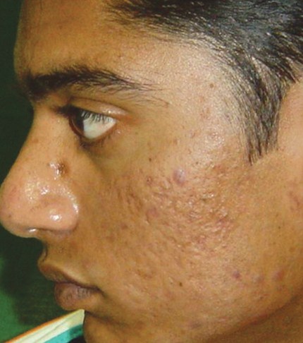 A photo of someone receiving Pixel Skin Resurfacing treatment.