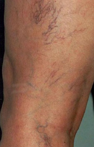 A photo of someone receiving Sclerotherapy treatment.