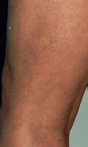 A photo of someone receiving Sclerotherapy treatment.