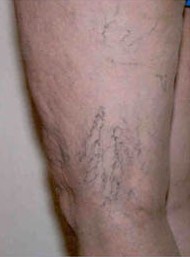 A photo of someone receiving Sclerotherapy treatment.
