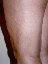 A photo of someone receiving Sclerotherapy treatment.