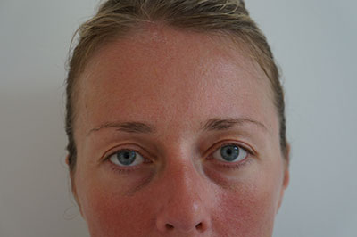 A photo of someone receiving ThreadLift (Silhouette Soft) treatment.