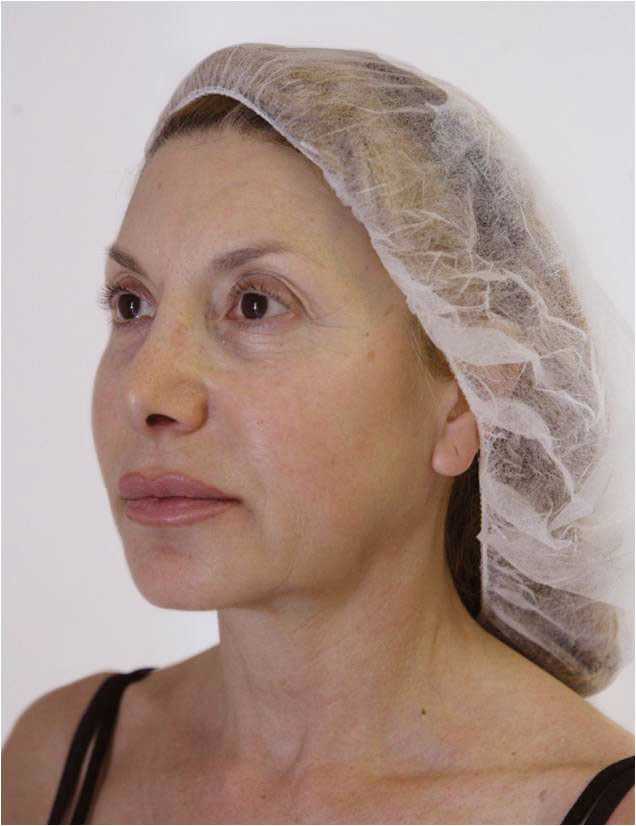 A photo of someone receiving ThreadLift (Silhouette Soft) treatment.