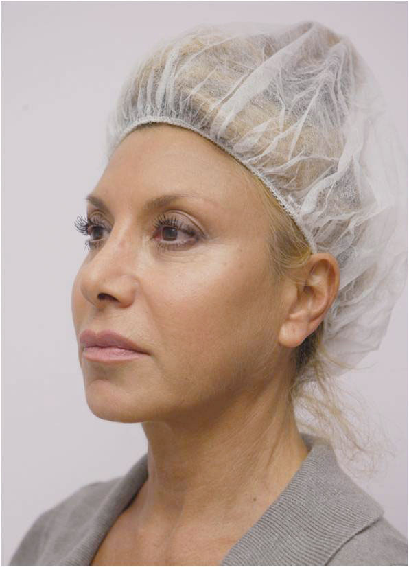 A photo of someone receiving ThreadLift (Silhouette Soft) treatment.