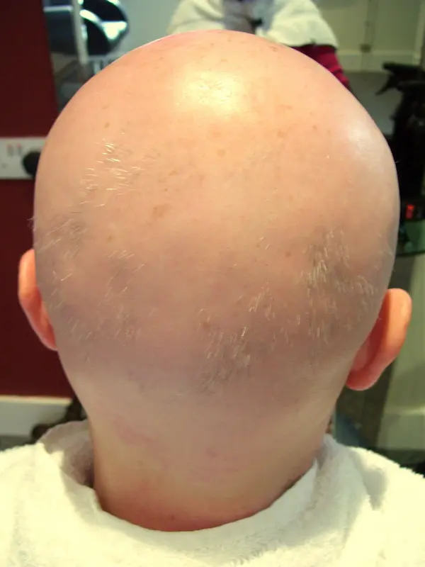 Alopecia Universalis (Total Hair Loss From the Whole Body)