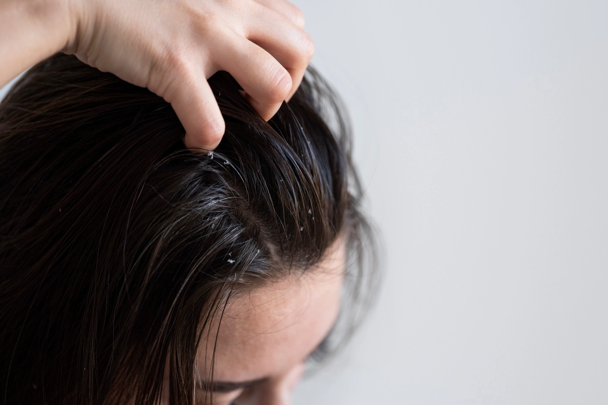 Itchy scalp relief