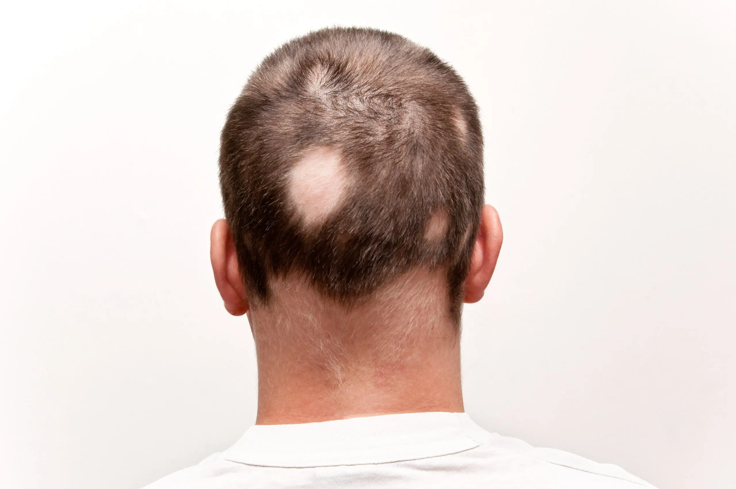 Alopecia Areata (Patchy Hair Loss)