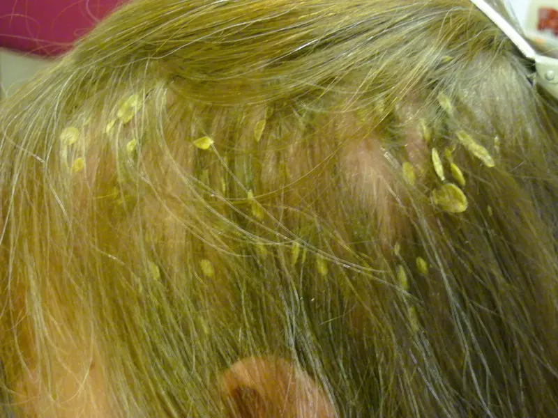 Pityriasis Amientacea (Severe Dandruff)