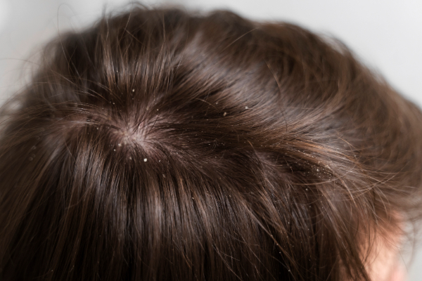 scalp conditions