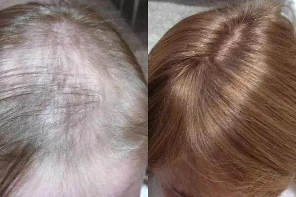 Teen Hair Loss Recovery